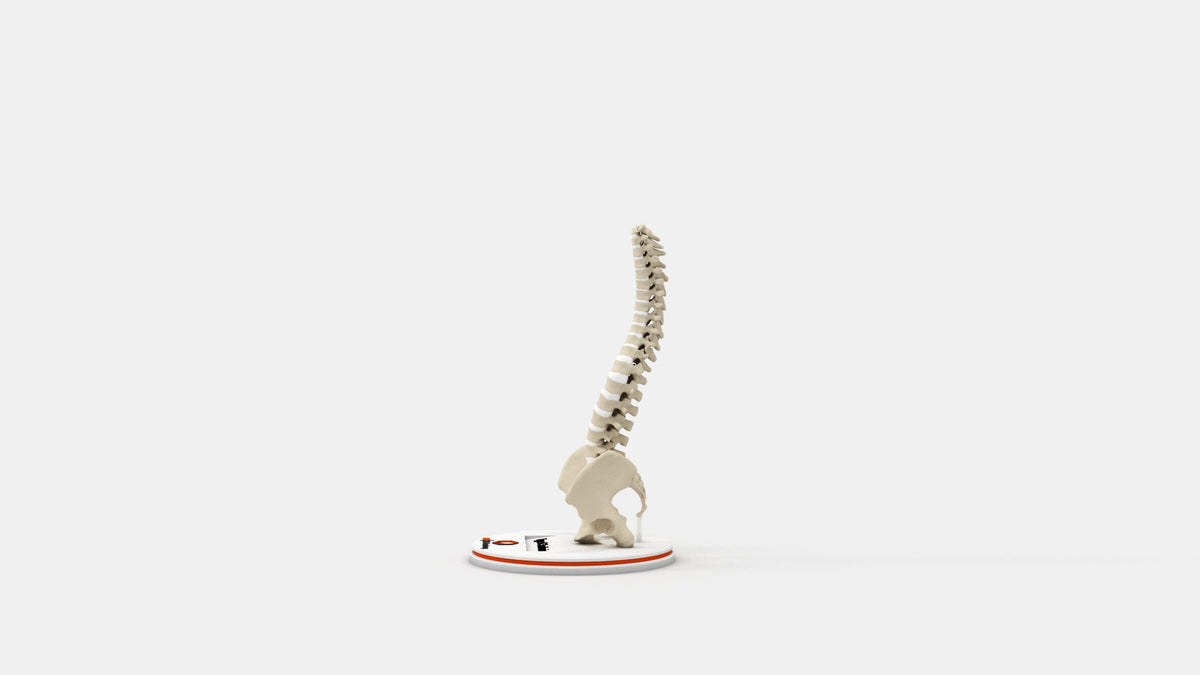 Scoliosis Type-6 Model 2