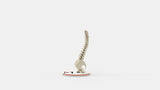 Scoliosis Type-6 Model 2