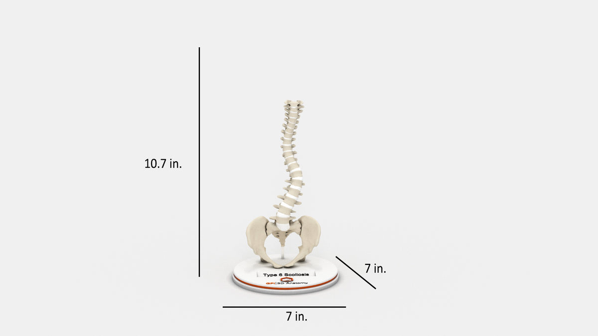Scoliosis Type-6 Model 2