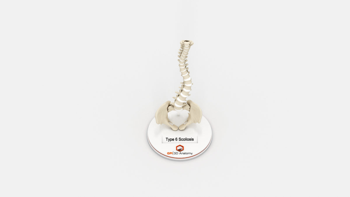 Scoliosis Type-6 Model 2