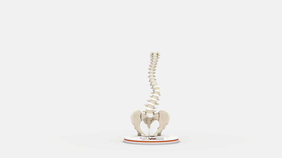 Scoliosis Type-6 Model 2