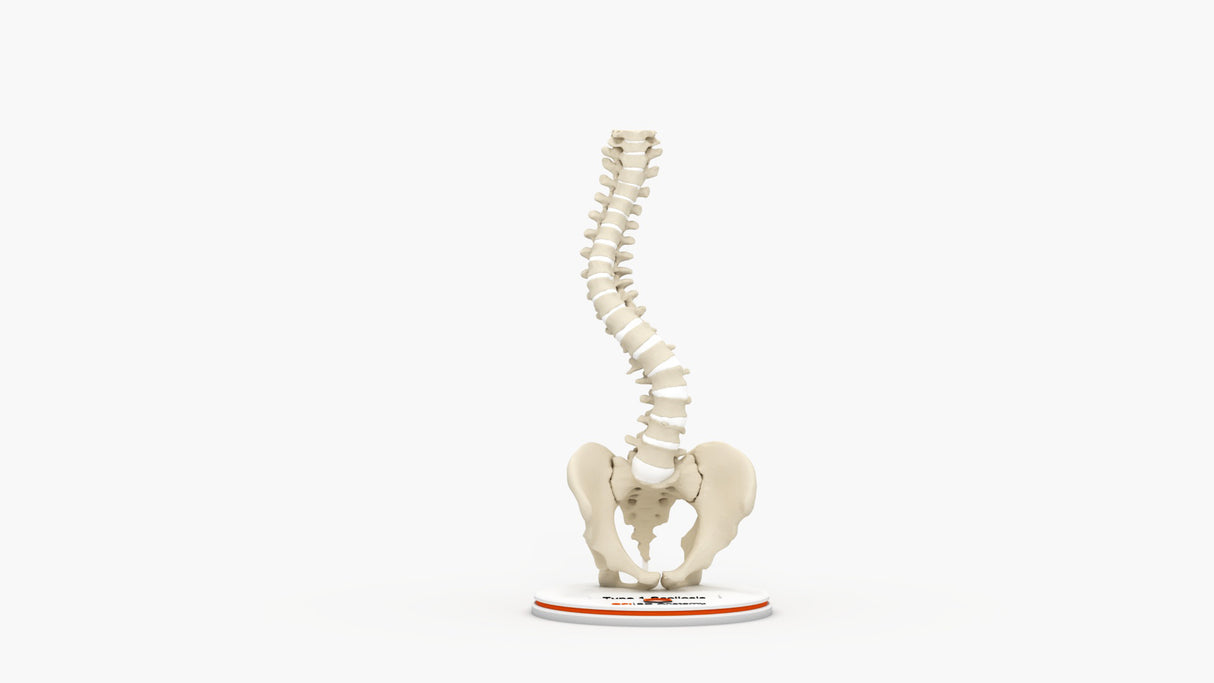 Scoliosis Type-1 Idiopathic 3