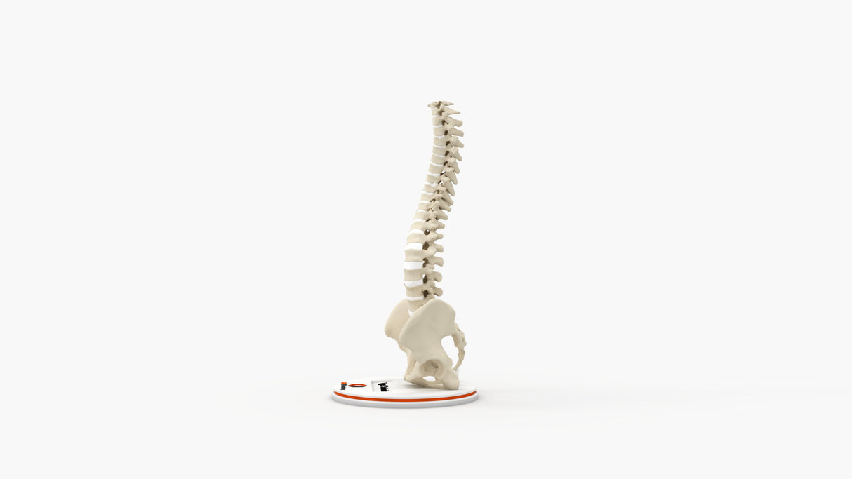 Scoliosis Type-1 Idiopathic 3