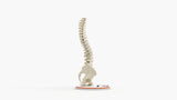 Scoliosis Type-1 Idiopathic 3