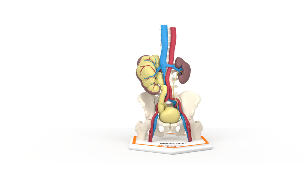 Mega Ureter – 48 M