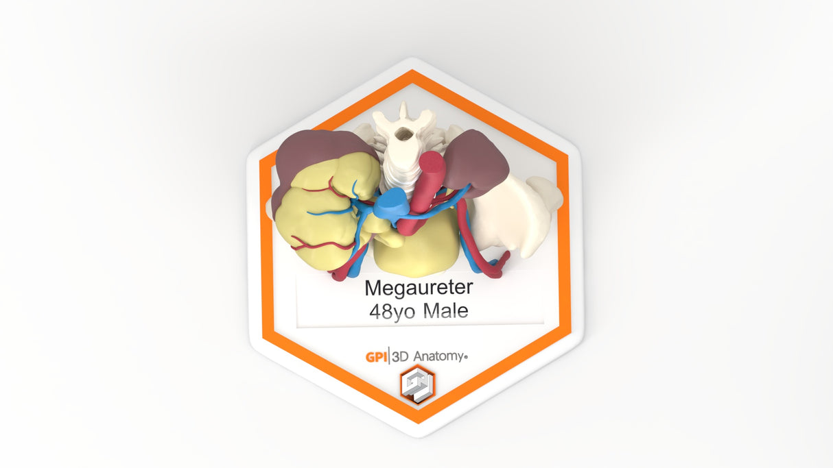 Mega Ureter – 48 M