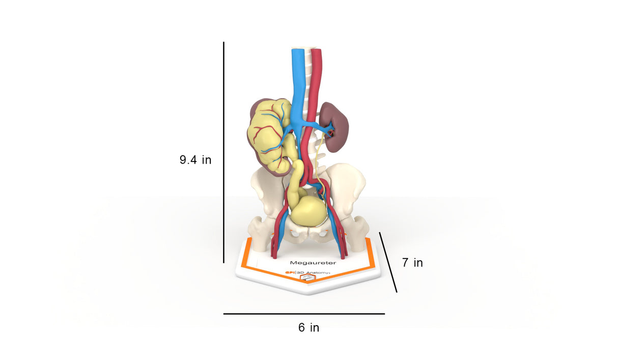 Mega Ureter – 48 M