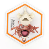 Zenker's Diverticulum (Pharyngoesophageal Diverticulum)