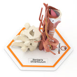 Zenker's Diverticulum (Pharyngoesophageal Diverticulum)