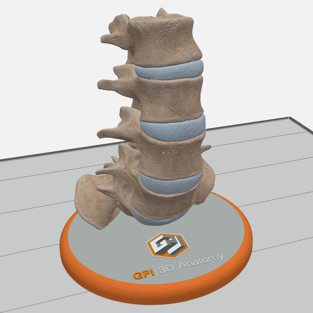 Custom 3D Anatomy Models | Spine | Spondylolisthesis | Pars Defect ...