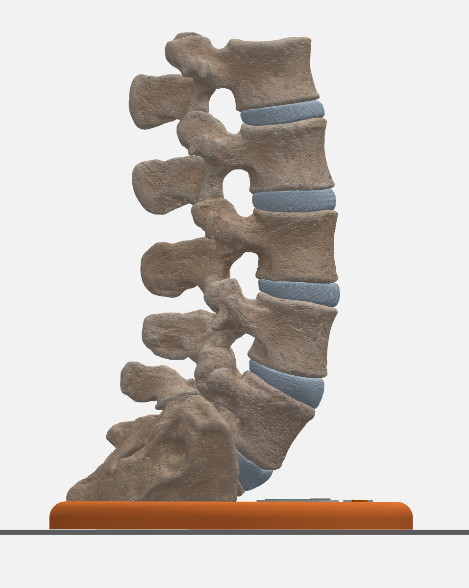 Custom 3D Anatomy Models | Spine | Spondylolysis | Pars Defect | Grade ...