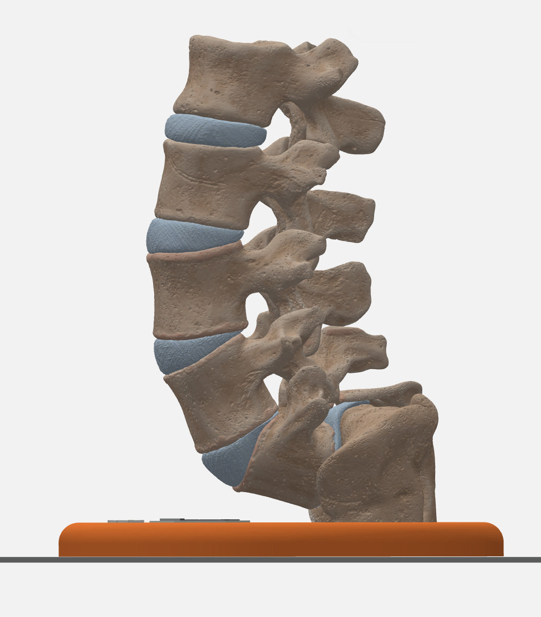 Custom 3D Anatomy Models | Spine | Spondylolisthesis | Pars Defect ...