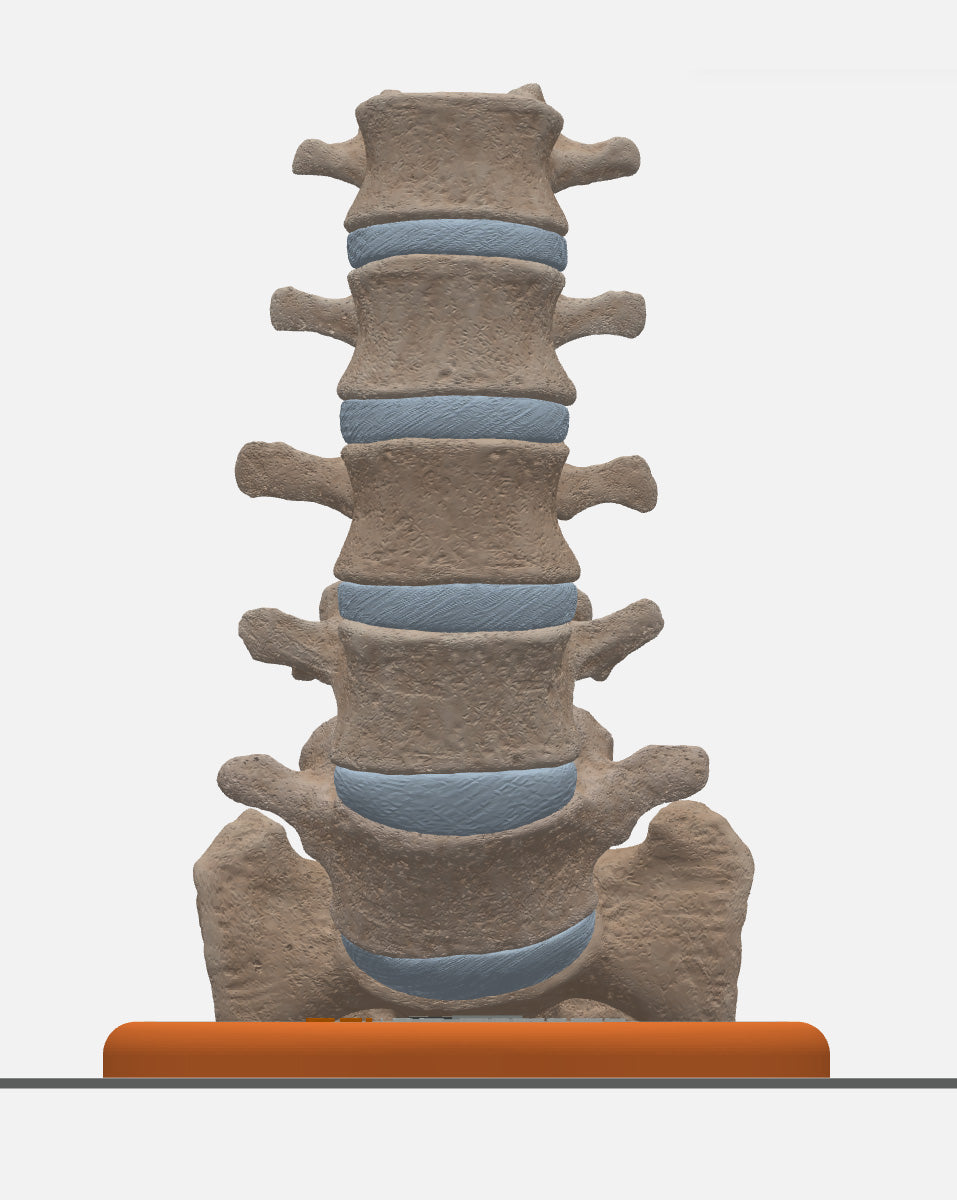 Pars Defect Cartoon Custom 3D Anatomy Models | Spine | Spondylolysis | Pars Defect | Grade ...