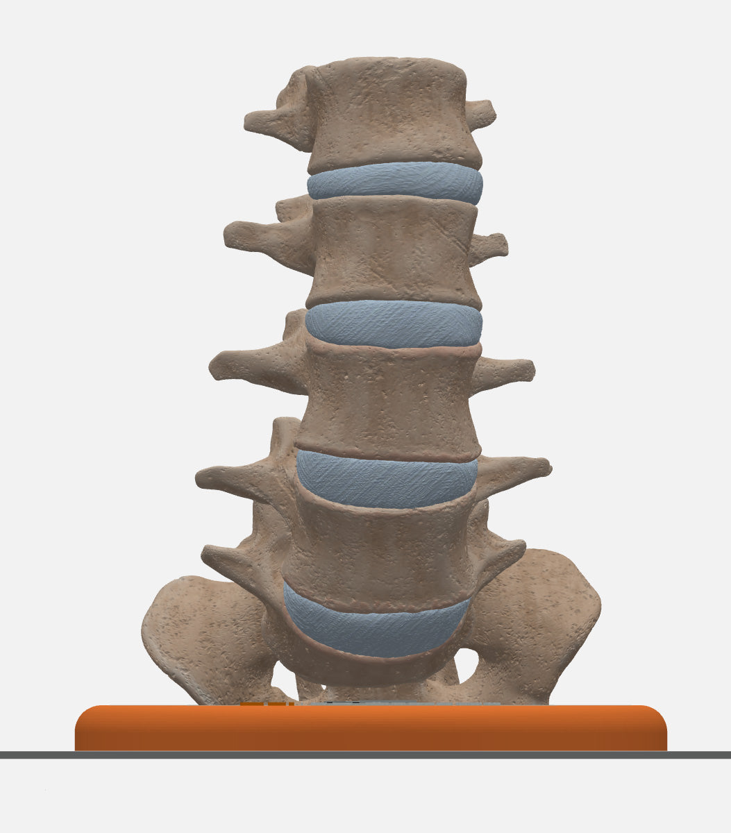Custom 3D Anatomy Models | Spine | Spondylolisthesis | Pars Defect ...