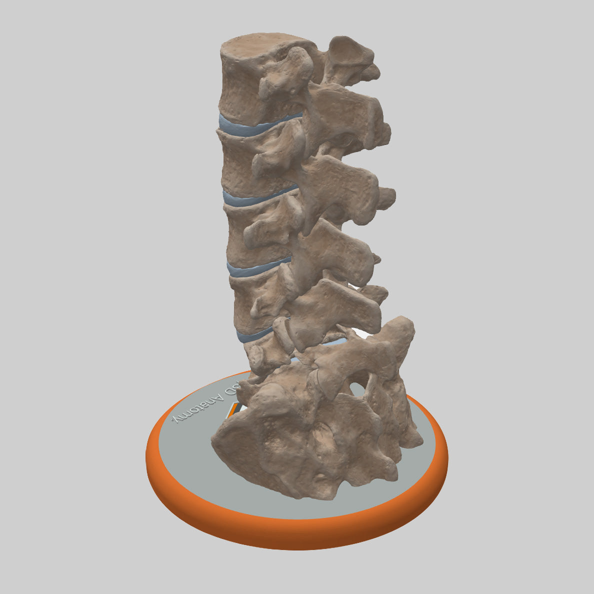 Custom 3D Anatomy Models | Spine | Spondylolysis | Pars Defect | Grade ...