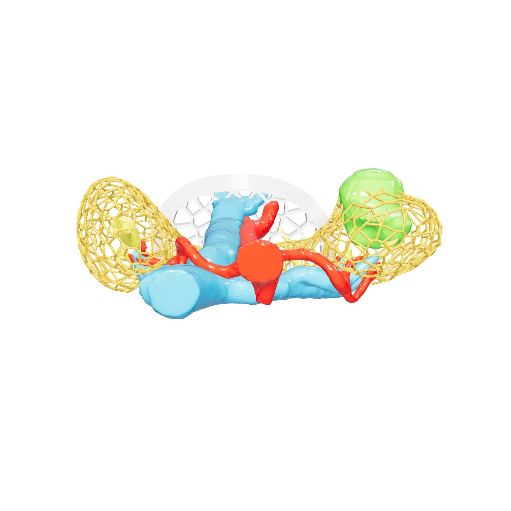 Custom 3D Anatomy Models Renal Cell Carcinoma Horseshoe Kidney